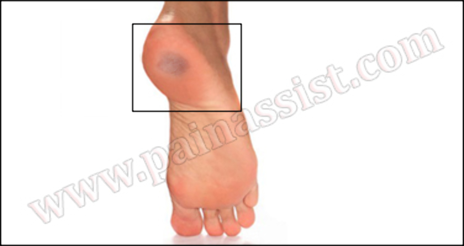 Bruised Heel pain assist photo 11 from album diseases and